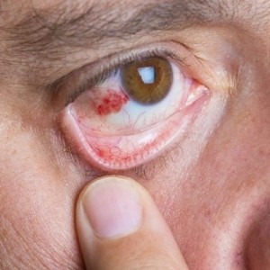 Những điều chưa biết về bệnh mắt đột quỵ